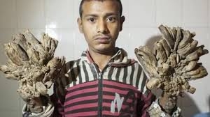 Tree man syndrome. Man survived living with four kg of warts on his hands and feet