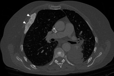 Man s skeletal tumour treated through radiofrequency abalation