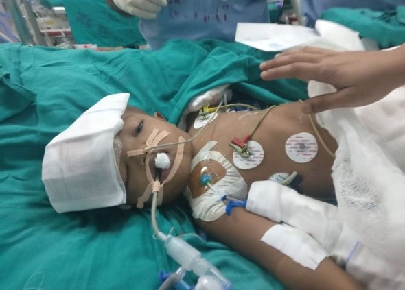 In a breakthrough, Surgeons at the Delhi AIIMS, have separated twin boys Jagga and Kalia, who were joined from the tops of their heads.