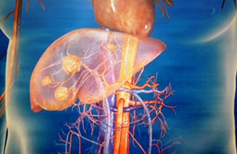 Bead Chemo Embolisation becoming the most preferred way of treatment for Liver cancer patients