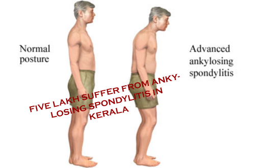  Five lakh suffer from ankylosing spondylitis in Kerala 