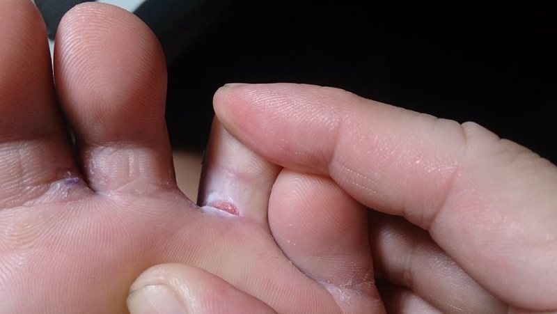 Home remedies for fungal infection in monsoon - Window To News