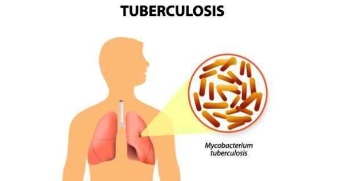 India has 27% of world's TB Patients, globally 4000 deaths daily:WHO