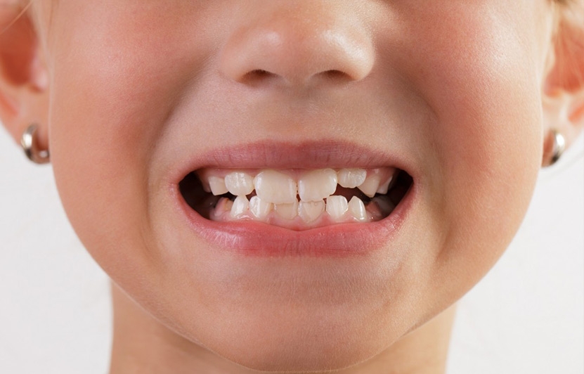 Have you notice your child’s teeth grinding habit?