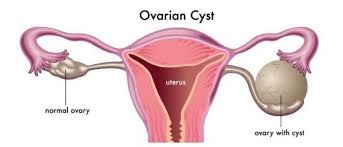  Simple ovarian cysts don't require surgical removal: Study 