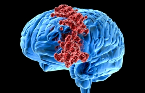  New drug shows promise in halting spread of brain cancer 