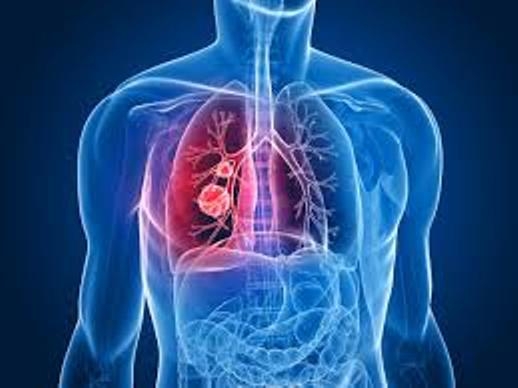  Lung disease in middle-aged people may up dementia later 