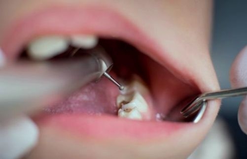  Woman in UK dies after all teeth removed 