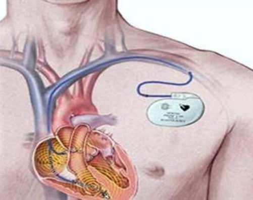 Know 'precautions' to be followed after implanting a pacemaker