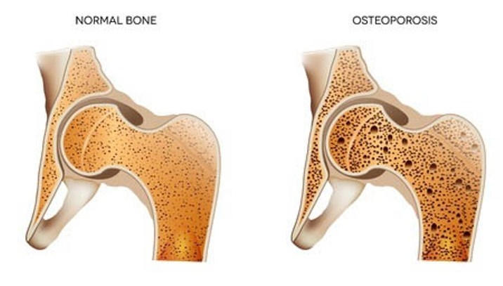 Osteoporosis: Prevention is possible 