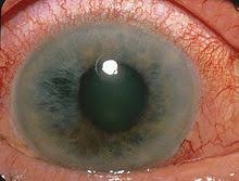  Potential biomarker of glaucoma identified 