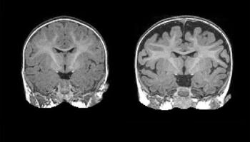  Baby teeth with heavy metals may predict autism risk 