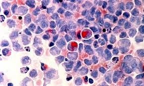   Ovarian tissue freezing  may provide hope for fertility treatment 