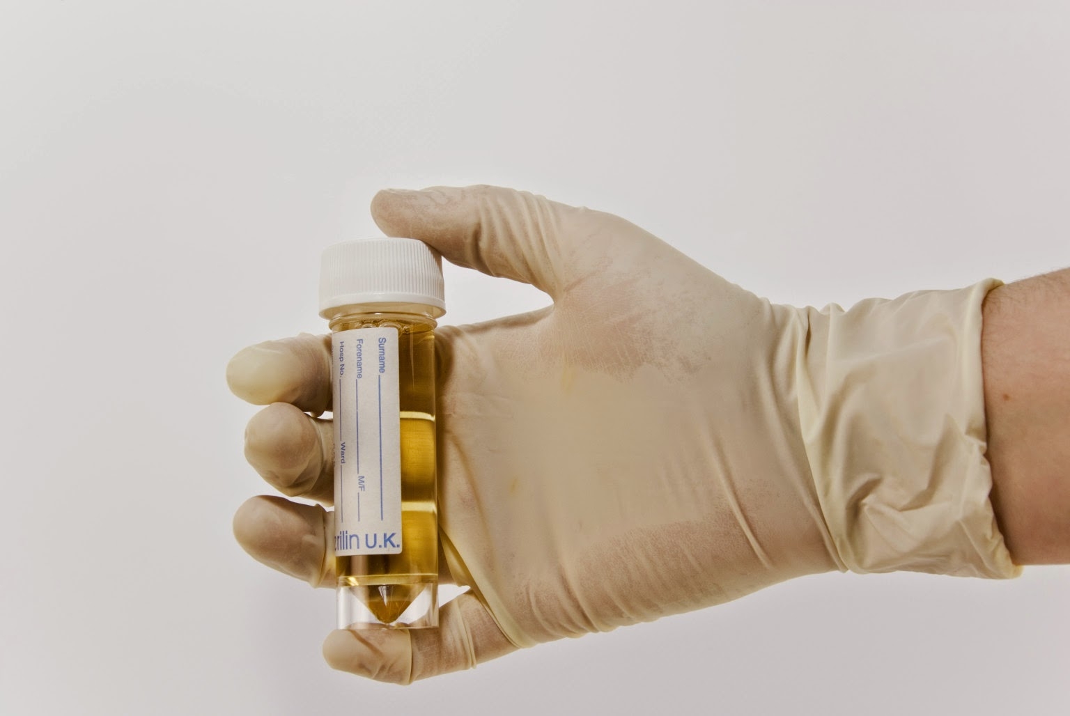  Detecting prostate cancer through urine sample 